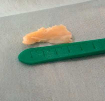 удаление внутреннего мениска коленного сустава