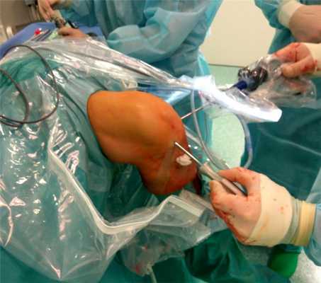 артроскопия коленного сустава фото