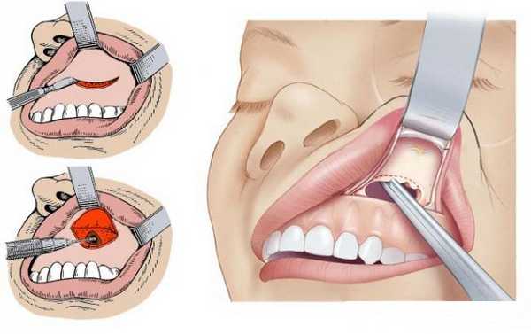 радикальная гайморотомия