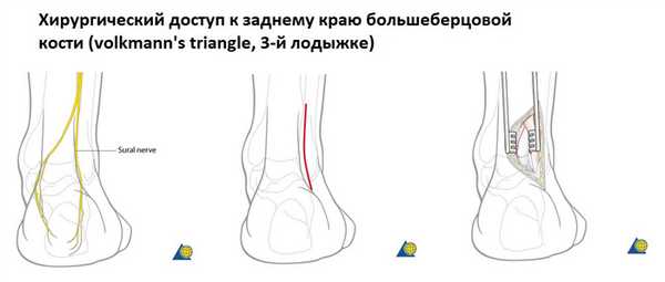 перелом заднего края большеберцовой кости