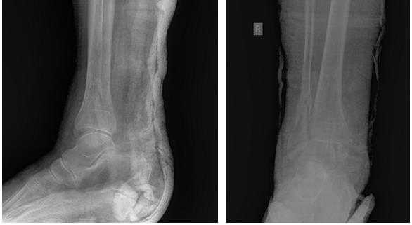 перелом обеих лодыжек