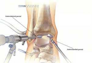 Артроскопическая пластика связки голеностопного сустава