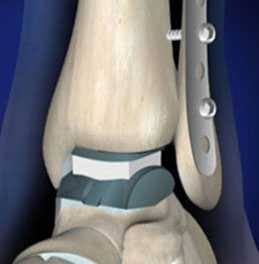sxema-endoproteza-golenostopnogo-sustava