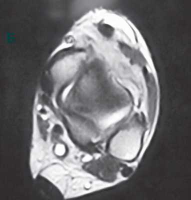 МРТ ганглия голени