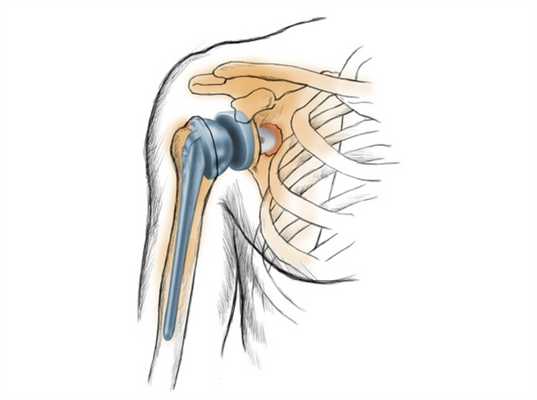 Эндопротезирование плечевого сустава