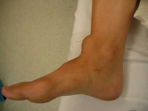 разрыв сухожилия большеберцовой мышцы