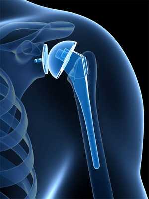 Операцию по эндопротезированию плечевого сустава