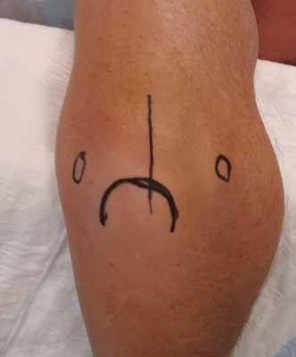 отрыв трицепса хирургический доступ