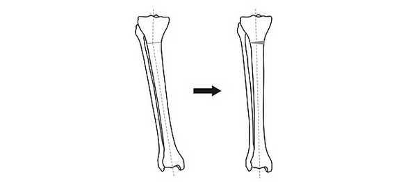 Схема исправления оси большеберцовой кости