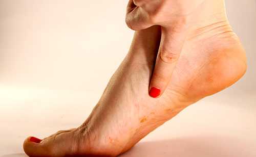 боль при плоскостопии