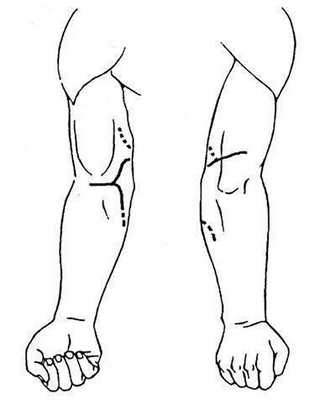 Линии доступов (пунктир) к передней и задней локтевым ямкам и их расширение (точки) при одновременной транспозиции локтевого нерва