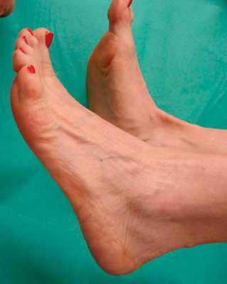 свисание стопы при разрыве сухожилия большеберцовой мышцы