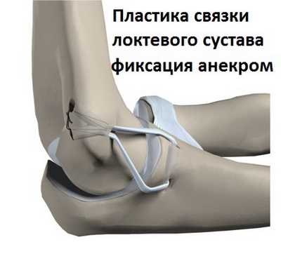 пластика медиальной коллатеральной связки