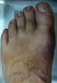 внешний-вид-стопы-после-операции