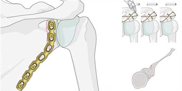 Остеосинтез при переломах лопатки