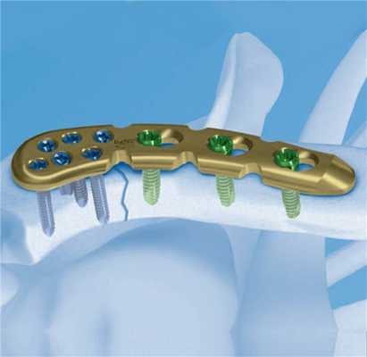 Остеосинтез при переломах костей верхних конечностей