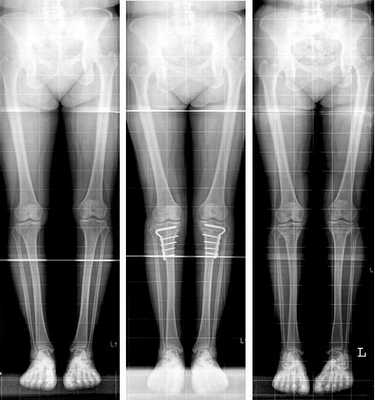 Коррекция оси нижней конечности при варусной деформации с помощью пластин