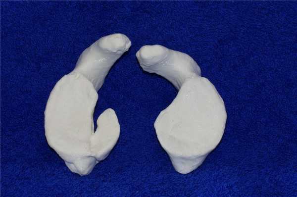 Костный банкарт