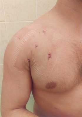 После артроскопической Латарже (1)