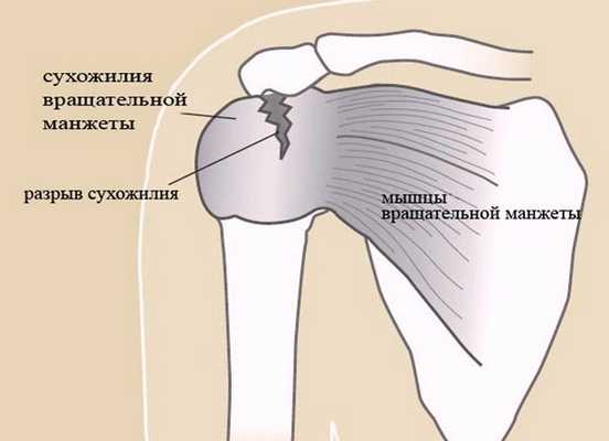 Повреждение вращательной манжеты