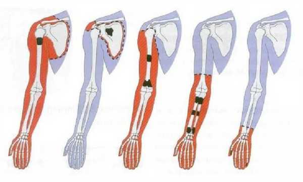 Уровни ампутации рук