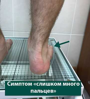симптом слишком много пальцев