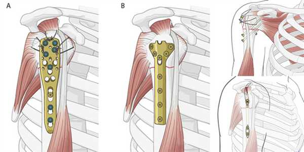 Остеосинтез при переломах верхних конечностей