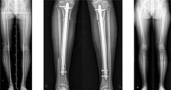 Коррекция оси нижней конечности при варусной деформации с помощью стержней (штифтов)