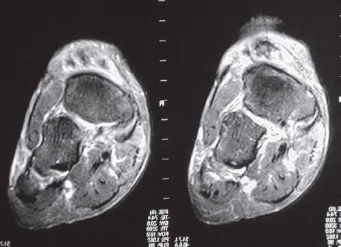 МРТ разыв сухожилия