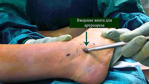 артроэрез ход операции