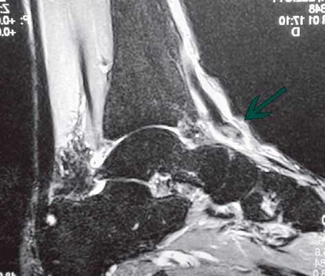 МРТ поврежедния сухожилия