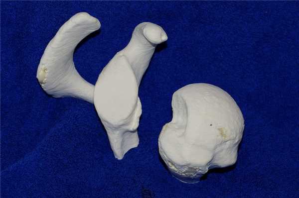 Дефект Хилл-Сакс (1)