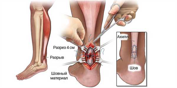 Операции на сухожилиях