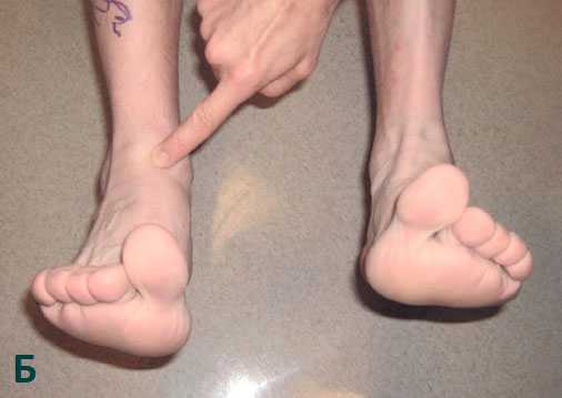 разрыв сухожилия большеберцовой мышцы