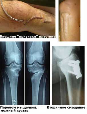 Осложнения остеосинтеза пластинами