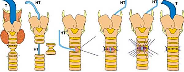 операции на трахее