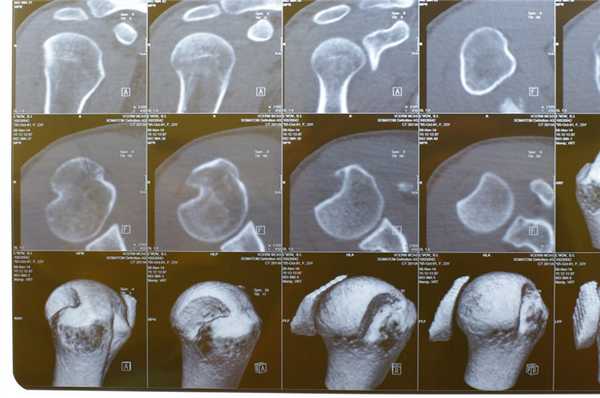 КТ дефект Хилла-Сакса
