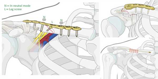 Остеосинтез при переломах ключицы