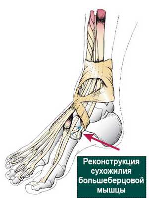 реконструкция сухожилия большеберцовой мышцы