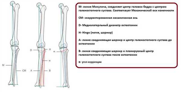 деформация ног