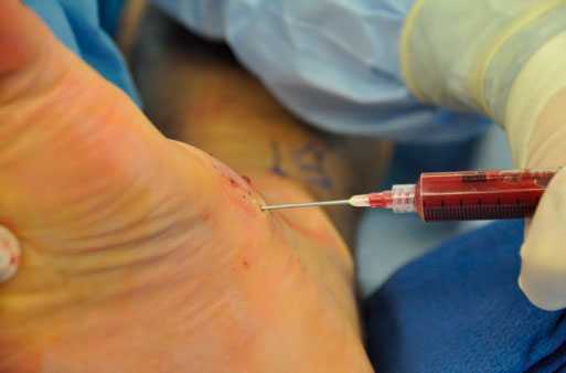 введение обогащенной трмбоцитами плазмы в стопу