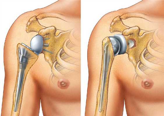 Разновидности эндопротезирования в плечевом суставе