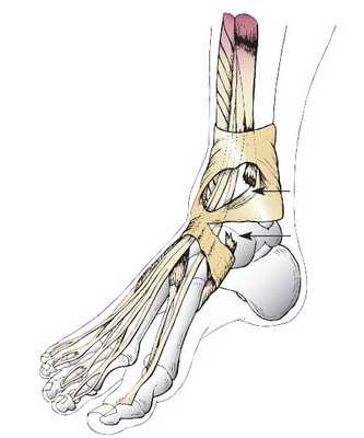 разрыв сухожилия передней большеберцовой мышцы