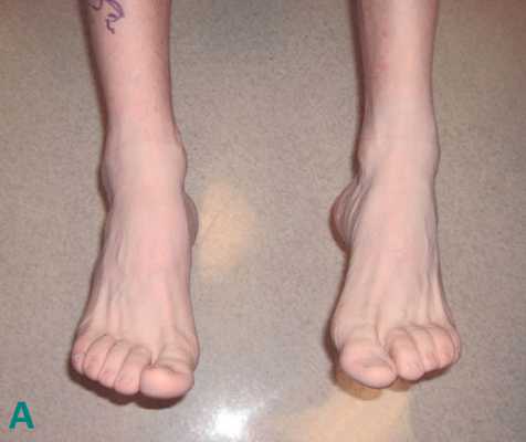 повреждение сухожилия большеберцовой мышцы