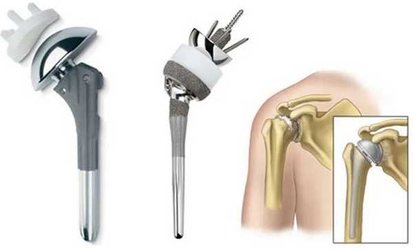 Эндопротезы плечевого сустава