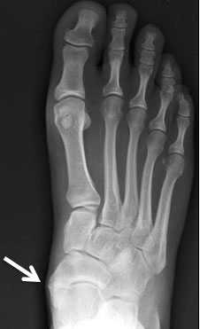 3 тип добавочной ладьевидной кости