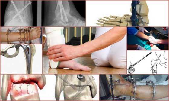 Артродез - операция, без которой не обойтись