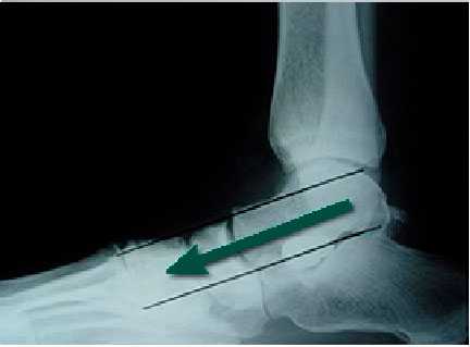 ПОСЛЕ АРТРОЭРЕЗА