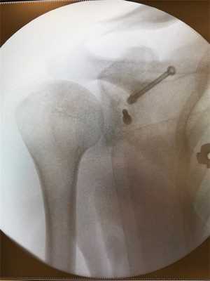 редкое осложнение после артроскопический операции Латарже-это миграция винта. В данном случае удаление металлоконструкции не требуется, т.к. Пересаженный костный блок прирос и функция полностью восстановилась.