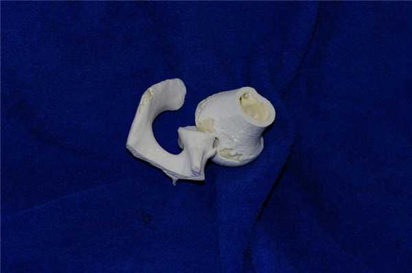 Дефект Хилл-Сакс (2)